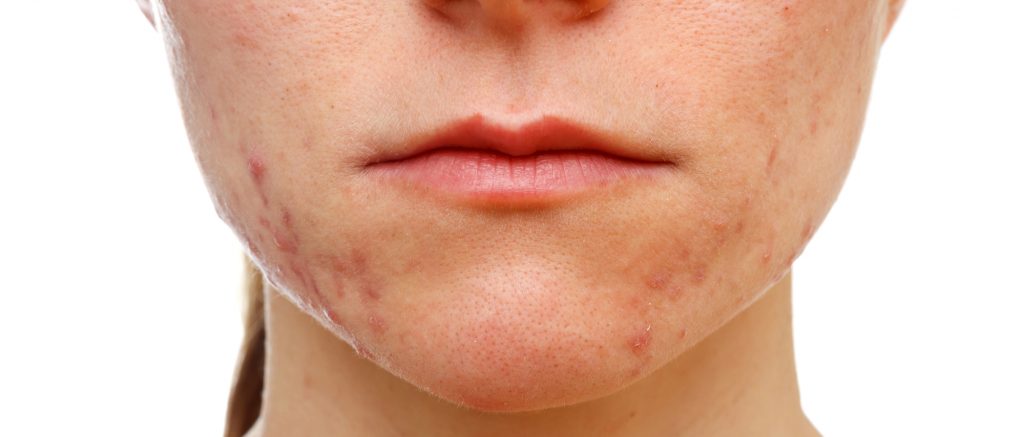 Accutane and the risk of scarring